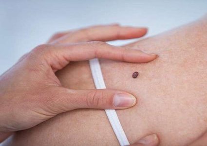 الميلانوما من العلامات المبكرة لهذا السرطان؟