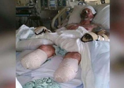 حبه للكلاب أفقده أطرافه وأنفه!