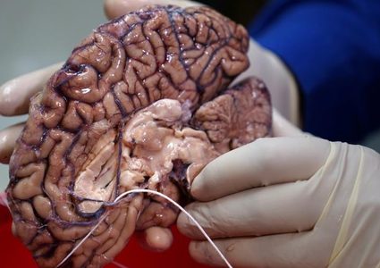 أزالوا سُدس مخه وظل طبيعيا !