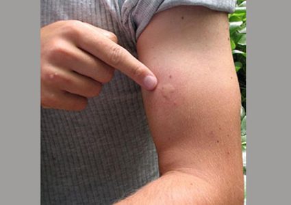 البعوض يؤرق ليل الغزيين يوميا ويسبب لهم الأمراض