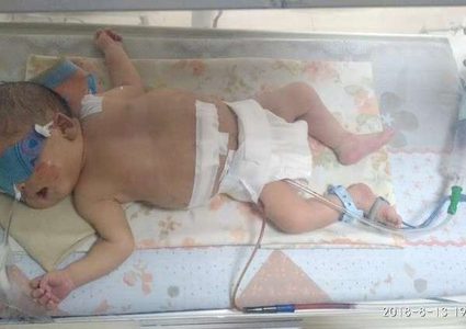 مولودة ابتلعت أختها في مصر!