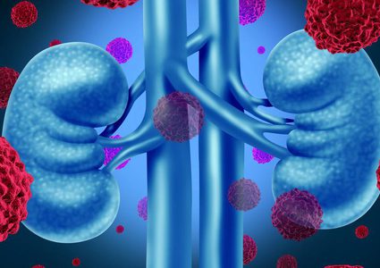 كيف يمكن التنبؤ بخطر الإصابة بسرطان الكلى؟