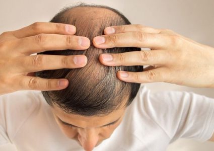 دراسة: هذه الأطعمة تسبب الصلع والشيب المبكّر