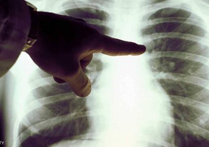 غيرات بسيطة في الأصابع تشير لإصابتك بسرطان الرئة