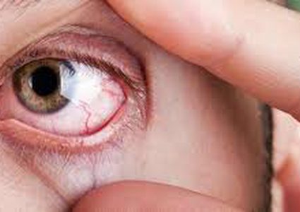 علماء يحذرون من زهري العيون المؤدي لفقدان البصر