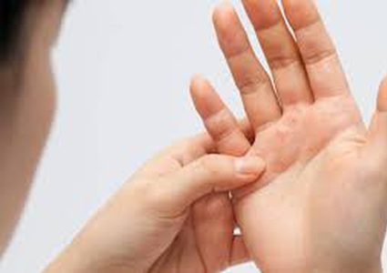 كيف تتعاملين مع حساسية الجلد "الاكزيما"؟