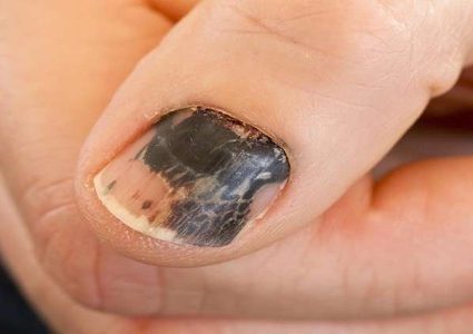 الأظافر تساعد في تشخيص السرطان