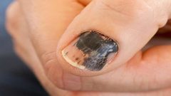 الأظافر تساعد في تشخيص السرطان