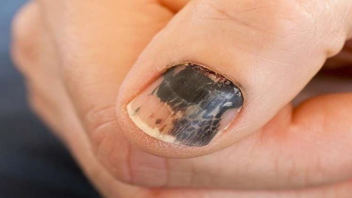 الأظافر تساعد في تشخيص السرطان