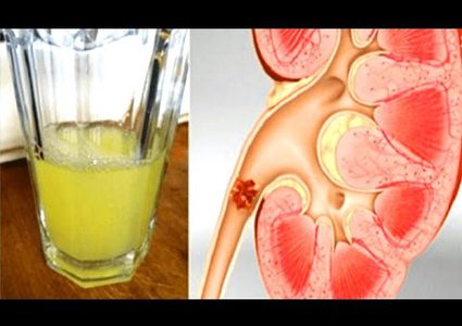 كوب واحد من هذا المشروب يفتت حصوات الكلى
