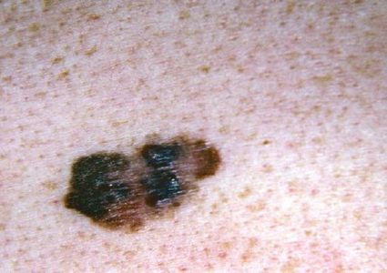 اكتشاف طريقة لمكافحة أخطر أنواع السرطان