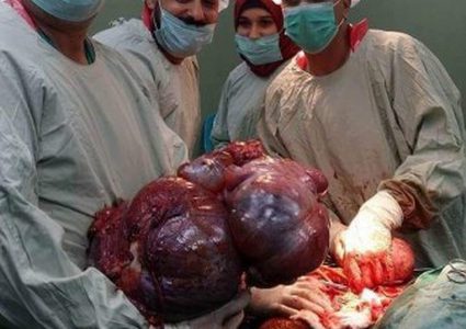 فريق طبي يستأصل ورماً لمريضة خمسينية