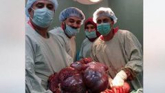 نجاح عملية استئصال ورم يزن 20 كيلو غرامًا لمريضة