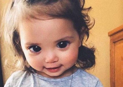 مرض نادر يعطي طفلة أمريكية عيونا كبيرة ومؤلمة!