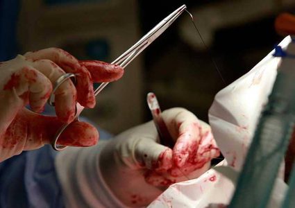 دراسة ثورية تجد بديلا ممكنا لعملية الزائدة الدودية