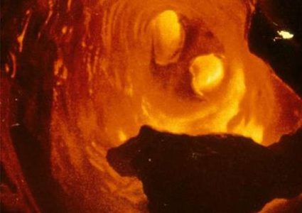 أسباب رئيسية لتكون الكوليسترول في الأوعية الدموية