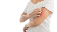 لتخفيف أعراض الصدفية.. إليك بالطب البديل
