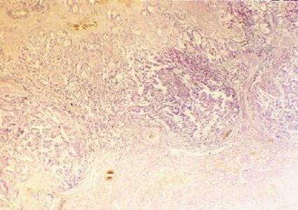 علماء روس يبتكرون جهازا لتشخيص السل وسرطان الرئة