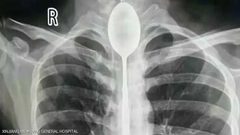 صيني يبتلع ملعقة ويعيش بها عاما كاملا