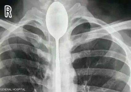 صيني يبتلع ملعقة ويعيش بها عاما كاملا