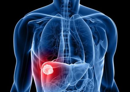 أعراض الإصابة بسرطان الكبد