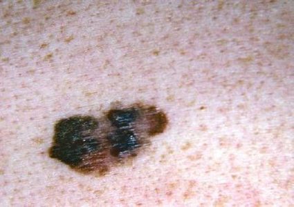 هل السرطان مرض معد؟