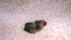 هل السرطان مرض معد؟