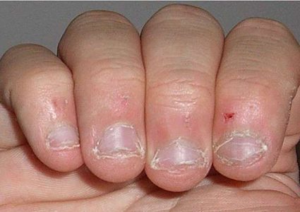 شارف على الموت بسبب عادة قضم الأظافر