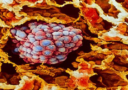 ما سبب سهولة انتشار السرطان؟