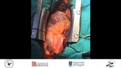 جراحون يجرون إحدى العمليات النادرة بالعالم