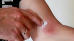 أبرز طرق التخفيف من أعراض الصدفية