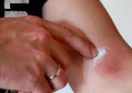 أبرز طرق التخفيف من أعراض الصدفية