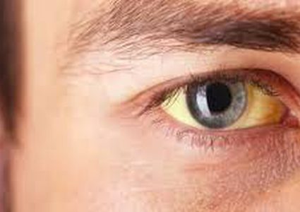 11 سبب لاصفرار العين و8 طرق طبيعية لعلاجها!