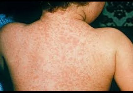 اصابة أكثر من 1400 شخص في إسرائيل بمرض الحصبة