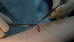 ابتكار جديد يعالج الجروح ولا يخلف ندوبا!