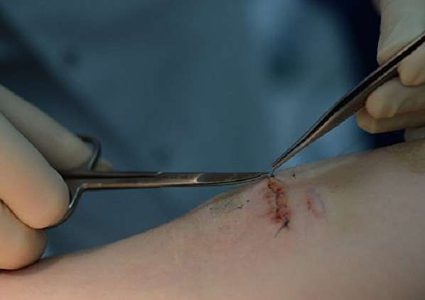 ابتكار جديد يعالج الجروح ولا يخلف ندوبا!