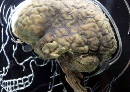 بكتيريا في أدمغة البشر ..كيف وصلت وماذا تفعل؟