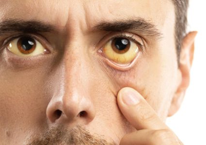 اليرقان: أسبابه، الفحوصات اللازمة لتشخيصه، علاجه!