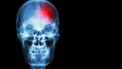 كيف تكتشف الإصابة بـ"السكتة الدماغية" بشكل مبكر ؟