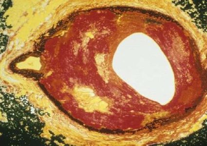 اكتشاف دواء لتصلب الشرايين