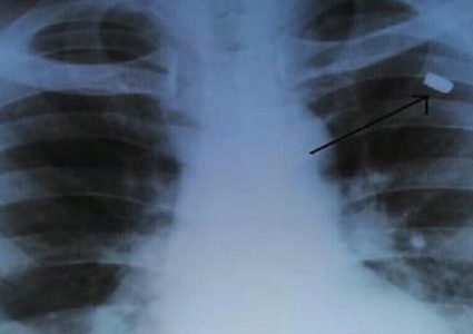 أطباء يستخرجون رصاصة بقيت في صدر رجل 30 سنة!