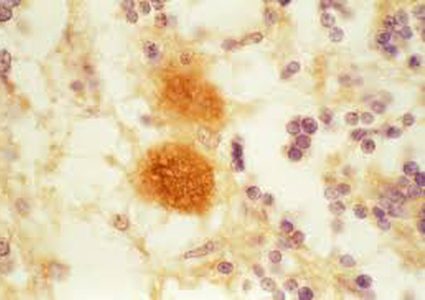 "مرض وراثي" يقضي على عائلة بأكملها!