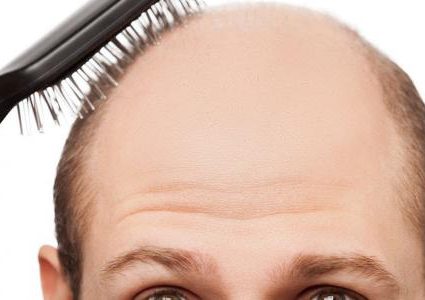 علماء يكتشفون علاجا لمشكلة الصلع