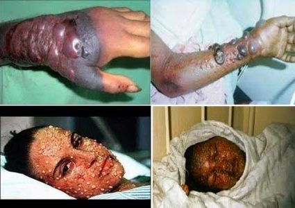 فيروس "إيبولا" يحصد أرواح العشرات بالكونغو