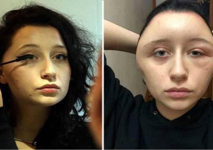 سيدة فرنسية تشوه رأسها بسبب "صبغة الشعر"!