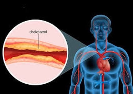 صور الشرايين المسدودة لدى المرضى تدفعهم للعلاج