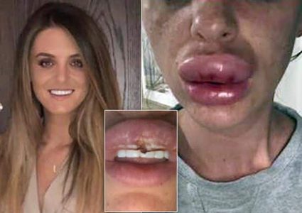 البوتوكس الخاطئ يحول سيدة بريطانية إلى "مسخ"