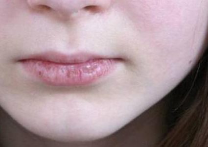 أسباب وأعراض جفاف الشفاه عند الأطفال