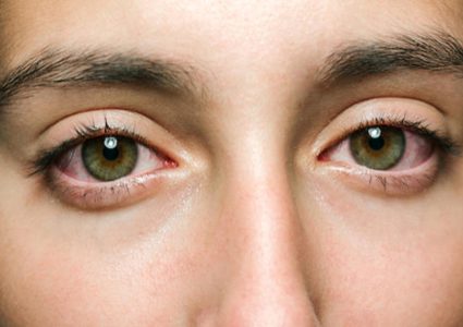 كيف تعالج حساسية العين؟