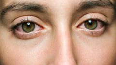 كيف تعالج حساسية العين؟